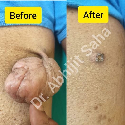 Skin tag removal