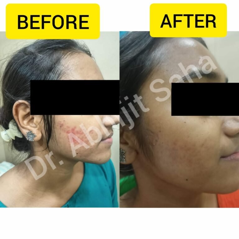 distressing acne scar